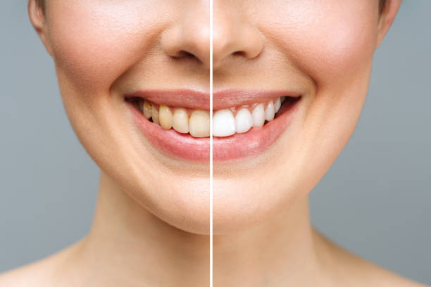 Teeth before professional whitening treatment at Dr. Dhanshree's Dental Clinic, Lohegaon, Pune